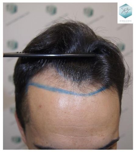Injerto Capilar Técnica FUE 2077 Grafts (5647 Pelos) 4 trasplante de pelo valencia