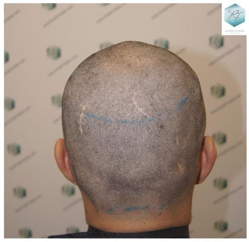 Injerto Capilar Técnica FUE 2077 Grafts (5647 Pelos) 12 trasplante de pelo valencia