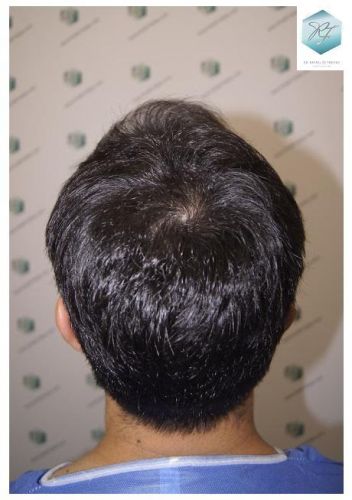Injerto Capilar Técnica FUE 2077 Grafts (5647 Pelos) 43 trasplante de pelo valencia