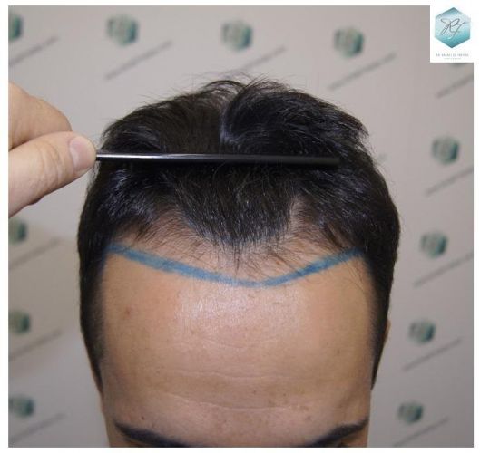 Injerto Capilar Técnica FUE 2077 Grafts (5647 Pelos) 1 trasplante de pelo valencia