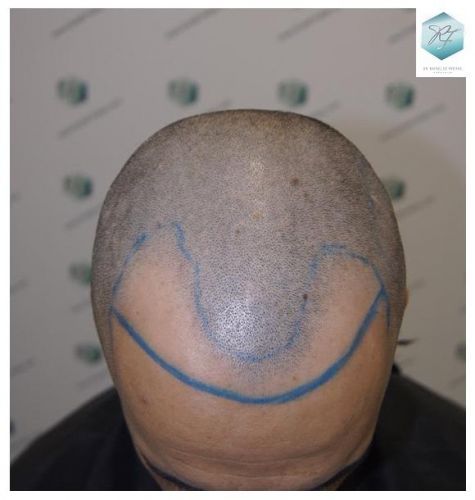 Injerto Capilar Técnica FUE 2077 Grafts (5647 Pelos) 9 trasplante de pelo valencia