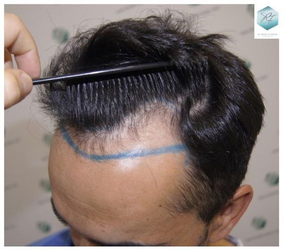 Injerto Capilar Técnica FUE 2077 Grafts (5647 Pelos) 6 trasplante de pelo valencia