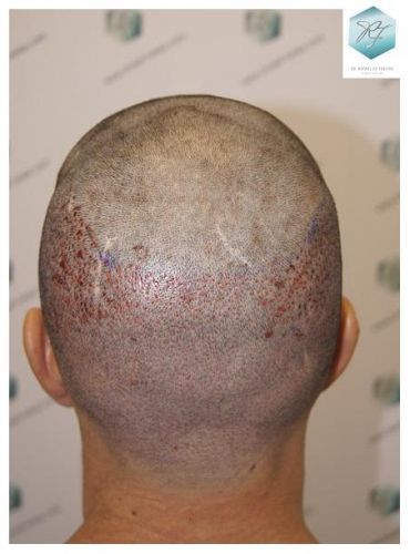 Injerto Capilar Técnica FUE 2077 Grafts (5647 Pelos) 18 MICROINJERTO CAPILAR