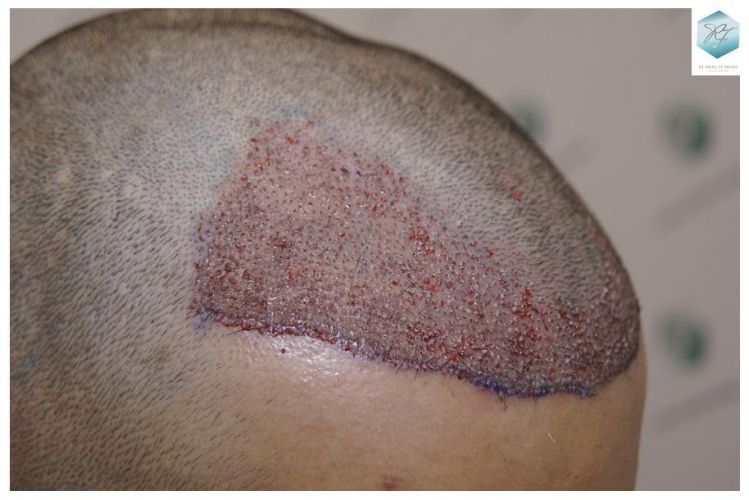 Injerto Capilar Técnica FUE 2077 Grafts (5647 Pelos) 16 MICROINJERTO CAPILAR