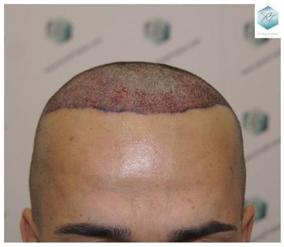 Injerto Capilar Técnica FUE 2077 Grafts (5647 Pelos) 13 MICROINJERTO CAPILAR
