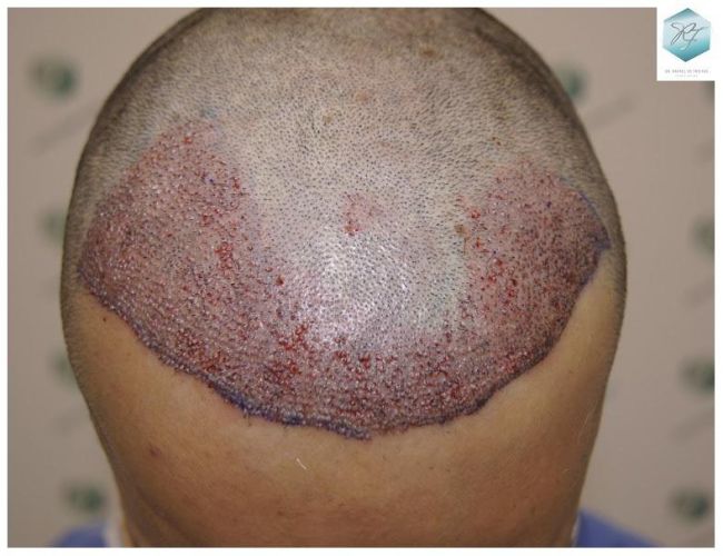 Injerto Capilar Técnica FUE 2077 Grafts (5647 Pelos) 15 MICROINJERTO CAPILAR
