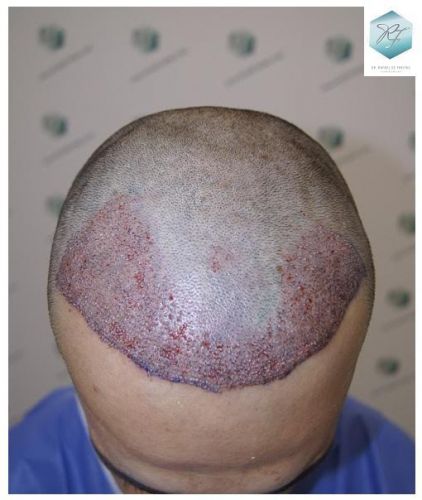 Injerto Capilar Técnica FUE 2077 Grafts (5647 Pelos) 14 MICROINJERTO CAPILAR