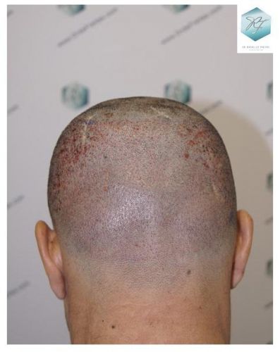 Injerto Capilar Técnica FUE 2077 Grafts (5647 Pelos) 19 MICROINJERTO CAPILAR