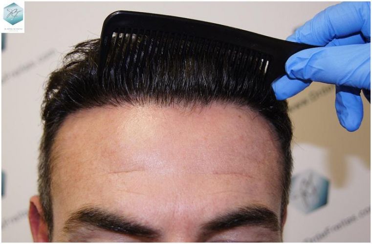 Injerto Capilar Técnica FUE 1804 Grafts (3746 Pelos) 18 TECNICA FUE