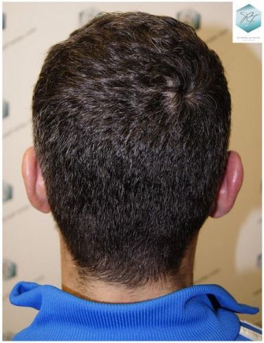 Injerto Capilar Técnica FUE 1804 Grafts (3746 Pelos) 22 TECNICA FUE