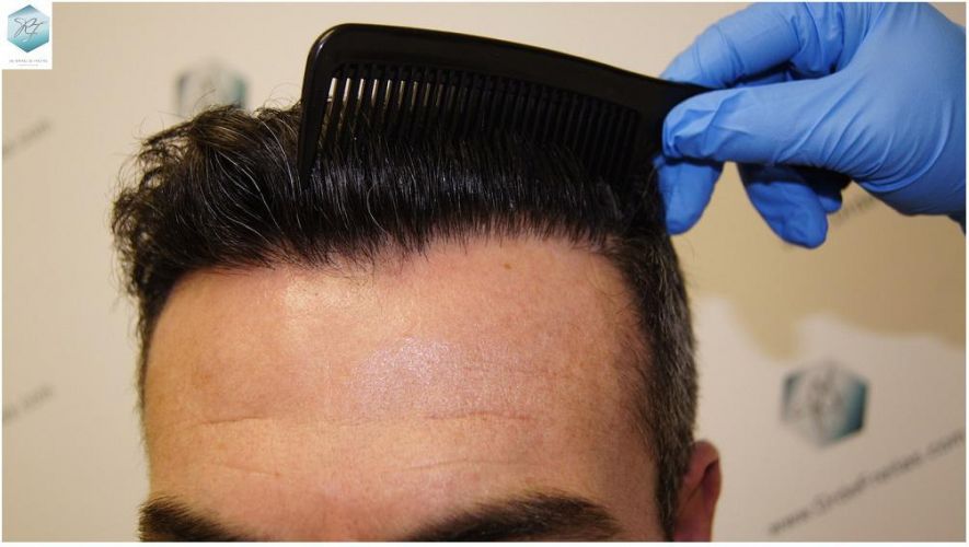 Injerto Capilar Técnica FUE 1804 Grafts (3746 Pelos) 17 TECNICA FUE