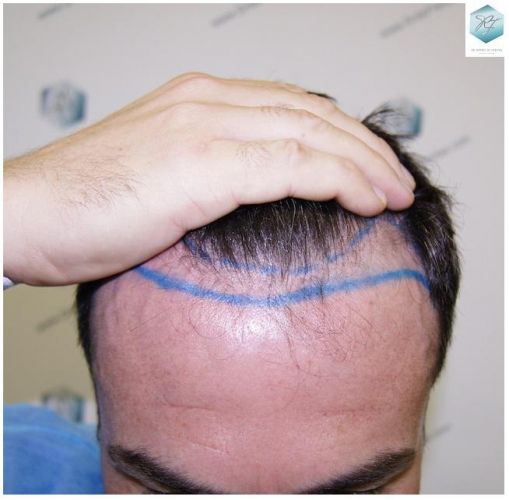 Injerto Capilar Técnica FUE 1804 Grafts (3746 Pelos) 2 MICROINJERTO CAPILAR