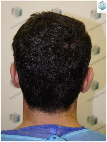 Injerto Capilar Técnica FUE 1804 Grafts (3746 Pelos) 25 MICROINJERTO CAPILAR