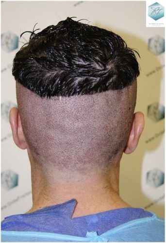 Injerto Capilar Técnica FUE 1804 Grafts (3746 Pelos) 15 MICROINJERTO CAPILAR