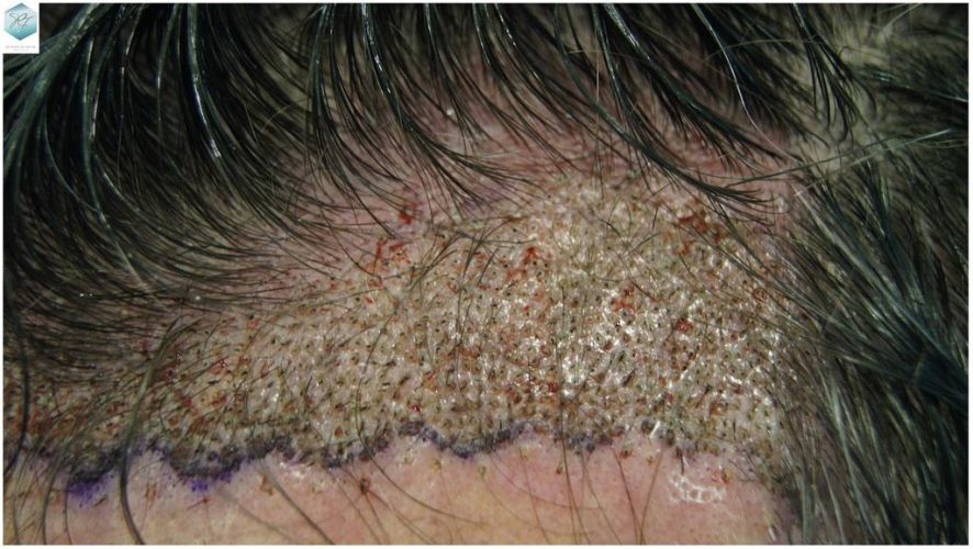 Injerto Capilar Técnica FUE 1804 Grafts (3746 Pelos) 12 MICROINJERTO CAPILAR