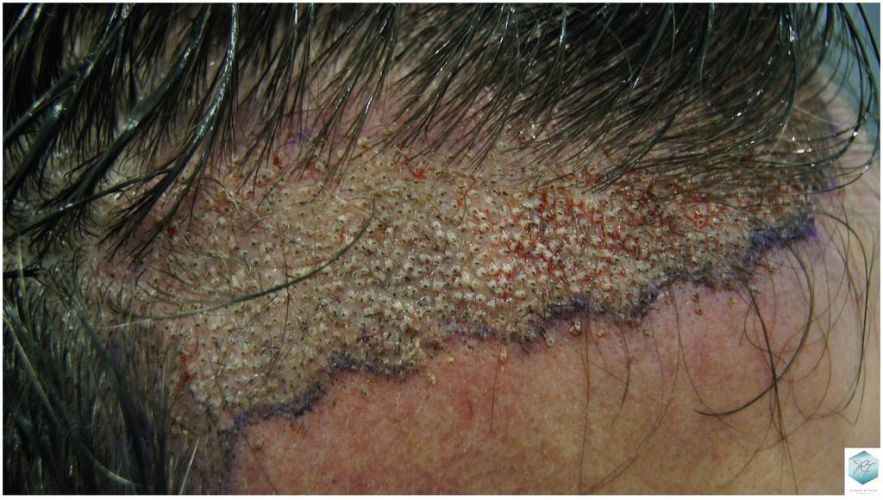 Injerto Capilar Técnica FUE 1804 Grafts (3746 Pelos) 11 MICROINJERTO CAPILAR