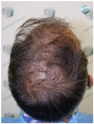 Injerto Capilar Técnica FUE 3180 Grafts (7446 Pelos) 2 TECNICA FUE
