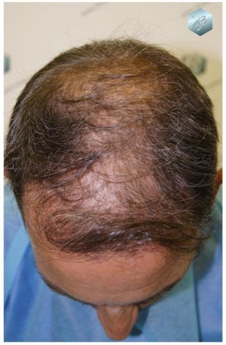 Injerto Capilar Técnica FUE 3180 Grafts (7446 Pelos) 1 TECNICA FUE