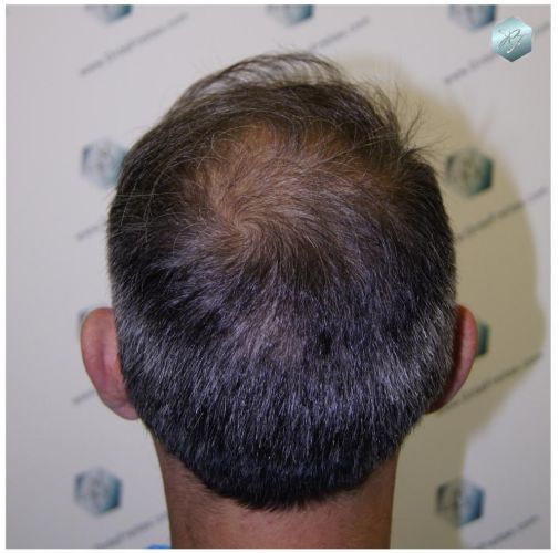 Injerto Capilar Técnica FUE 3180 Grafts (7446 Pelos) 13 TECNICA FUE