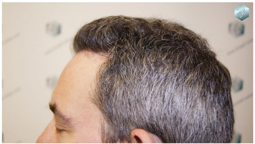Injerto Capilar Técnica FUE 3180 Grafts (7446 Pelos) 7 TRASPLANTE CAPILAR