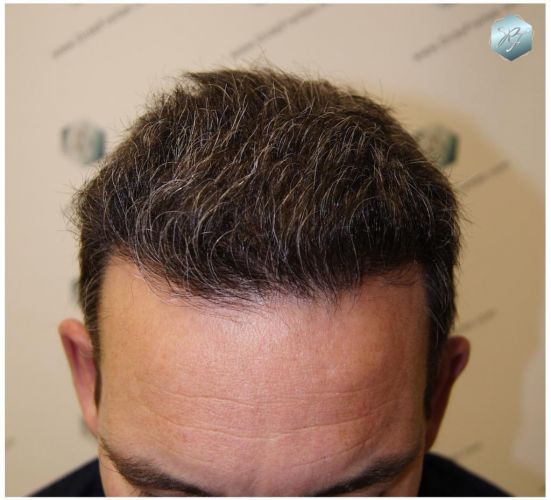 Injerto Capilar Técnica FUE 3180 Grafts (7446 Pelos) 10 TRASPLANTE CAPILAR