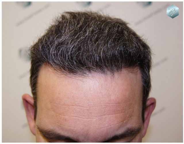Injerto Capilar Técnica FUE 3180 Grafts (7446 Pelos) 9 TRASPLANTE CAPILAR