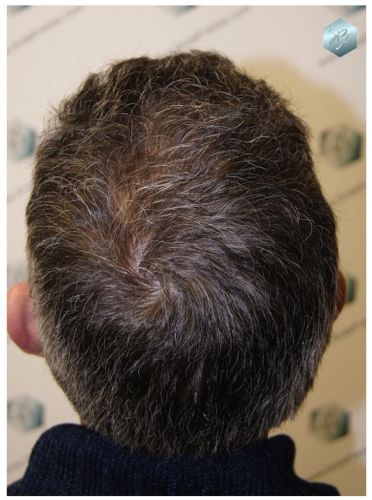 Injerto Capilar Técnica FUE 3180 Grafts (7446 Pelos) 12 TRASPLANTE CAPILAR