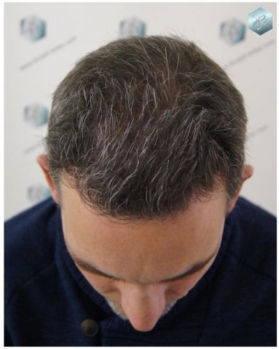 Injerto Capilar Técnica FUE 3180 Grafts (7446 Pelos) 11 TRASPLANTE CAPILAR