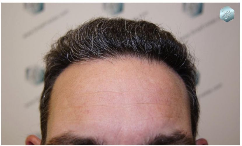 Injerto Capilar Técnica FUE 3180 Grafts (7446 Pelos) 8 TRASPLANTE CAPILAR
