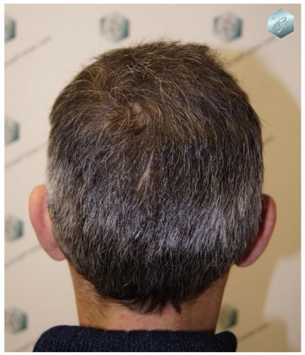 Injerto Capilar Técnica FUE 3180 Grafts (7446 Pelos) 3 TRASPLANTE CAPILAR