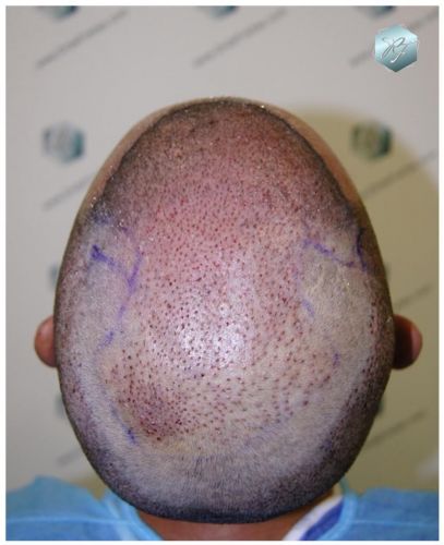 Injerto Capilar Técnica FUE 3180 Grafts (7446 Pelos) 5 TECNICA FUE