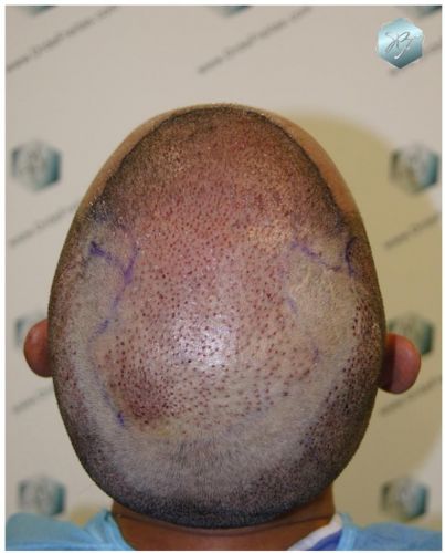 Injerto Capilar Técnica FUE 3180 Grafts (7446 Pelos) 4 TECNICA FUE