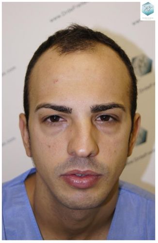 ANTES DEL TRASPLANTE CAPILAR TRASPLANTE CAPILAR