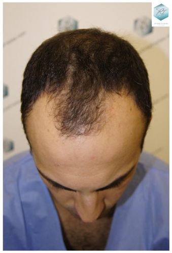 Injerto Capilar Técnica FUE 3018 Grafts (6498 Pelos) 1 TRASPLANTE CAPILAR