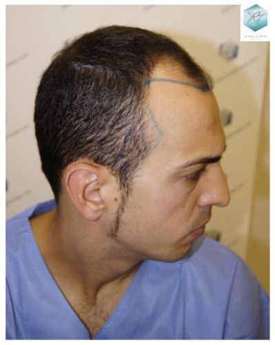 Injerto Capilar Técnica FUE 3018 Grafts (6498 Pelos) 4 TRASPLANTE CAPILAR