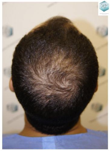 Injerto Capilar Técnica FUE 3018 Grafts (6498 Pelos) 37 TRASPLANTE CAPILAR