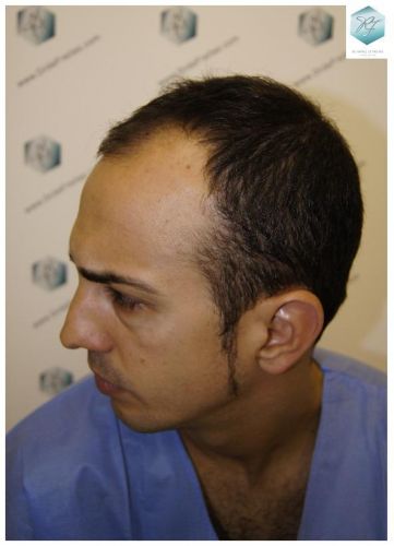 Injerto Capilar Técnica FUE 3018 Grafts (6498 Pelos) 3 TRASPLANTE CAPILAR