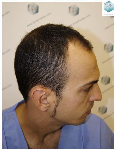 Injerto Capilar Técnica FUE 3018 Grafts (6498 Pelos) 2 TRASPLANTE CAPILAR