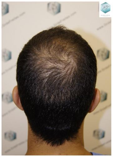 Injerto Capilar Técnica FUE 3018 Grafts (6498 Pelos) 36 TRASPLANTE CAPILAR