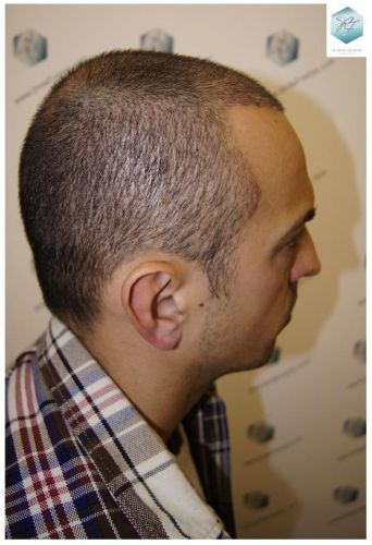 Injerto Capilar Técnica FUE 3018 Grafts (6498 Pelos) 22 IMPLANTE CAPILAR