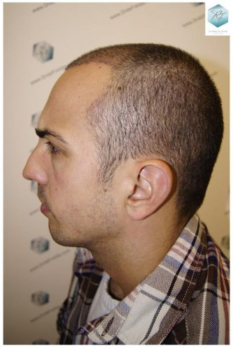 Injerto Capilar Técnica FUE 3018 Grafts (6498 Pelos) 23 ANTES-Y-DESPUES-TRASPLANTE-CAPILAR-CASO