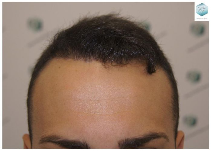 Injerto Capilar Técnica FUE 3018 Grafts (6498 Pelos) 29 ANTES-Y-DESPUES-TRASPLANTE-CAPILAR-CASO