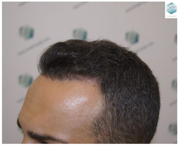 Injerto Capilar Técnica FUE 3018 Grafts (6498 Pelos) 31 ANTES-Y-DESPUES-TRASPLANTE-CAPILAR-CASO