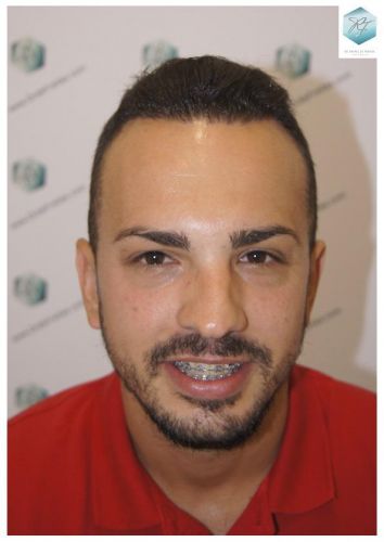 RESULTADOS 12 MESES ANTES-Y-DESPUES-TRASPLANTE-CAPILAR-CASO