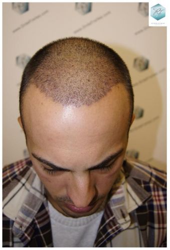 Injerto Capilar Técnica FUE 3018 Grafts (6498 Pelos) 21 ANTES-Y-DESPUES-TRASPLANTE-CAPILAR-CASO