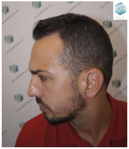 Injerto Capilar Técnica FUE 3018 Grafts (6498 Pelos) 28 ANTES-Y-DESPUES-TRASPLANTE-CAPILAR-CASO