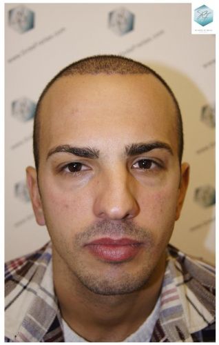 RESULTADOS A LOS 3 MESES IMPLANTE CAPILAR