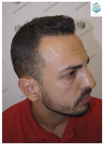 Injerto Capilar Técnica FUE 3018 Grafts (6498 Pelos) 27 IMPLANTE CAPILAR