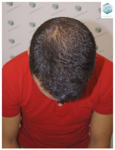 Injerto Capilar Técnica FUE 3018 Grafts (6498 Pelos) 26 IMPLANTE CAPILAR