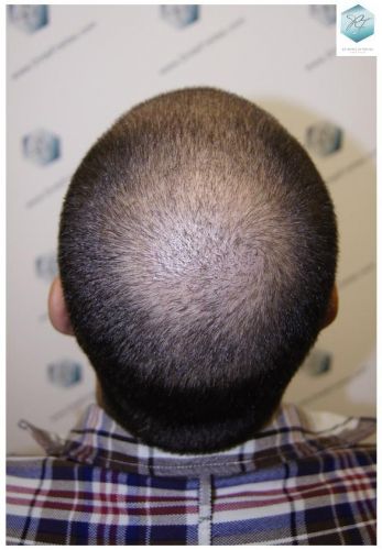 Injerto Capilar Técnica FUE 3018 Grafts (6498 Pelos) 24 IMPLANTE CAPILAR